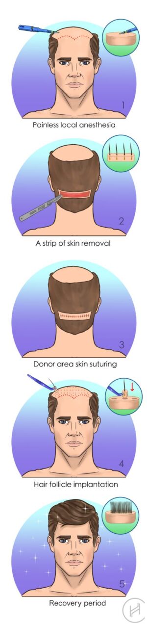 fut hair transplant procedure steps
