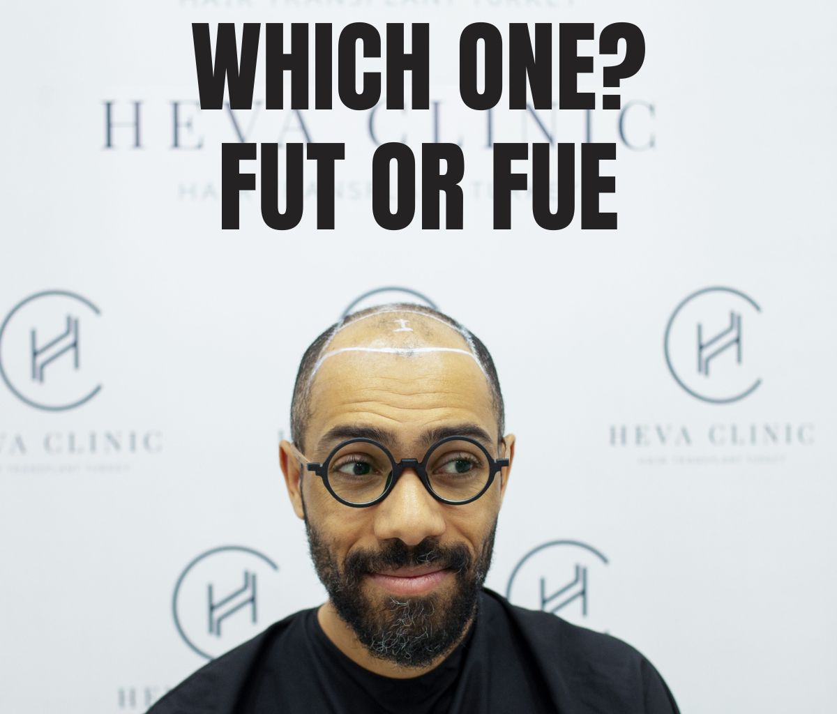 which one to choose? fut or fue hair transplant