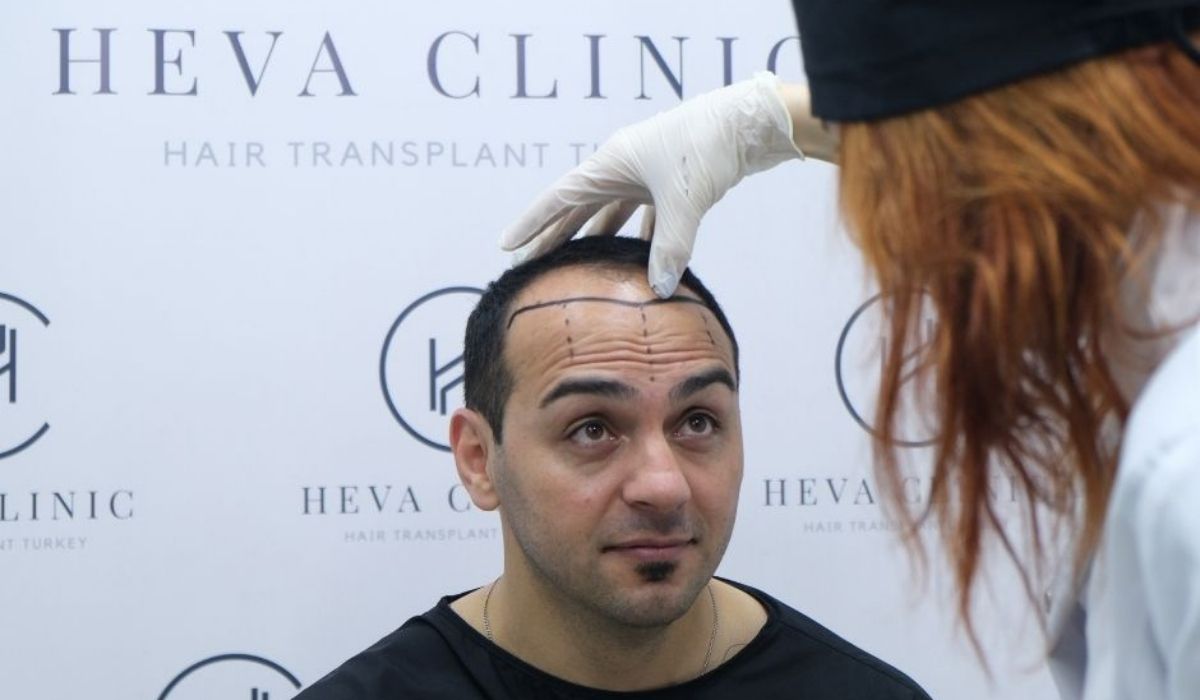 hair transplant consultation at heva clinic