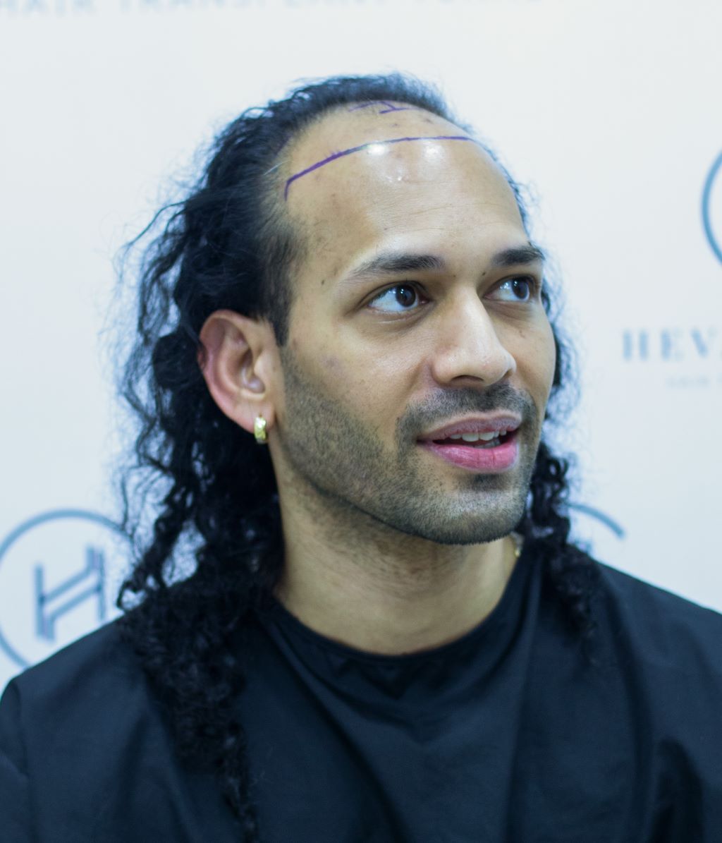 What Age Can I Get a Hair Transplant?