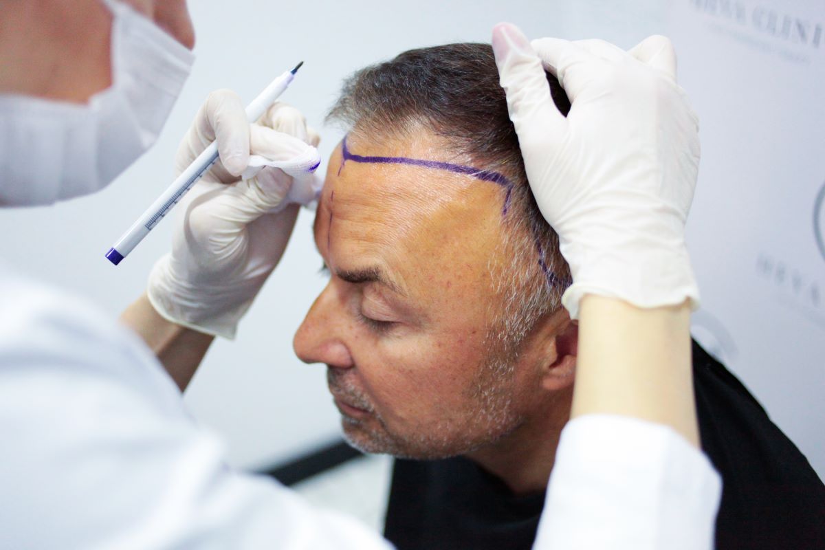 heva clinic hairline hair transplant