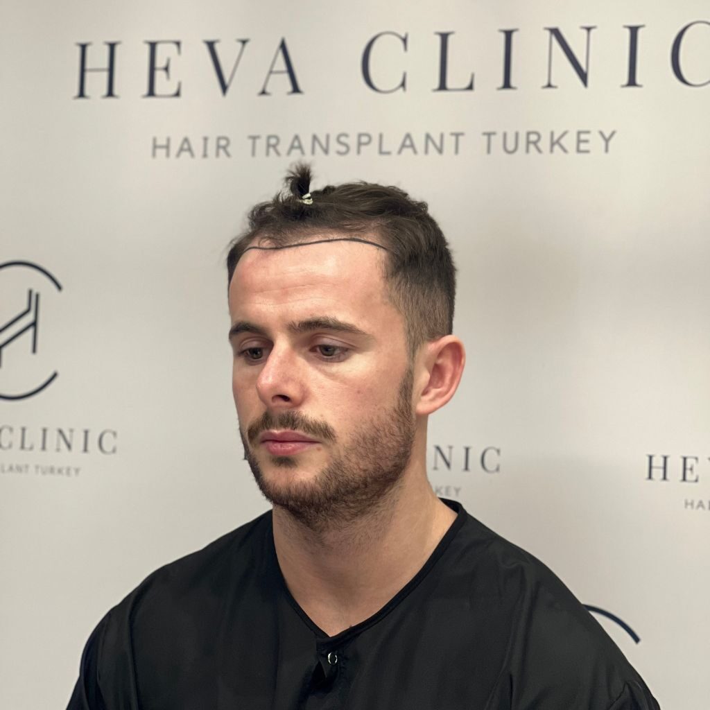 unshaven fue hair transplant patient at heva clinic istanbul turkey