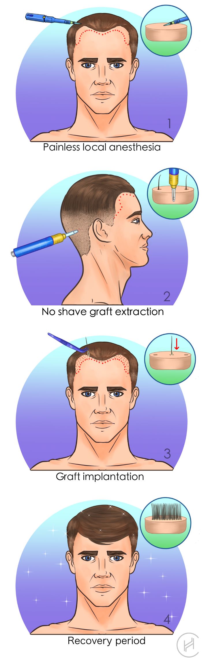 unshaven-u-fue-hair-transplant-procedure unshaven u-fue hair transplant procedure