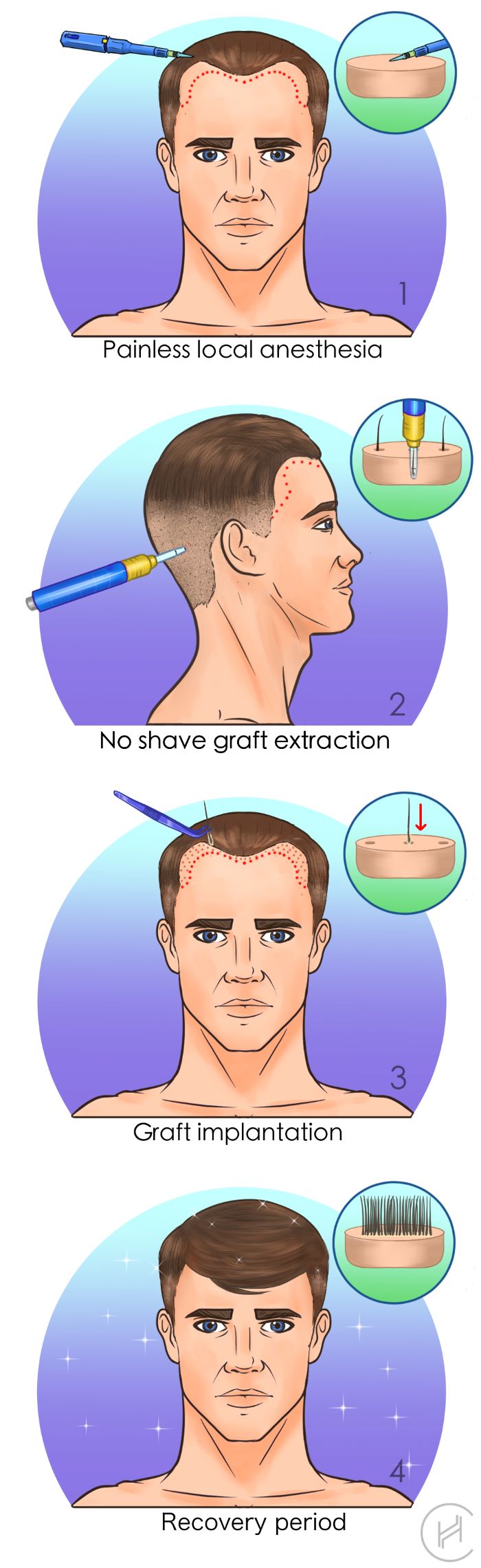 unshaven u-fue hair transplant procedure