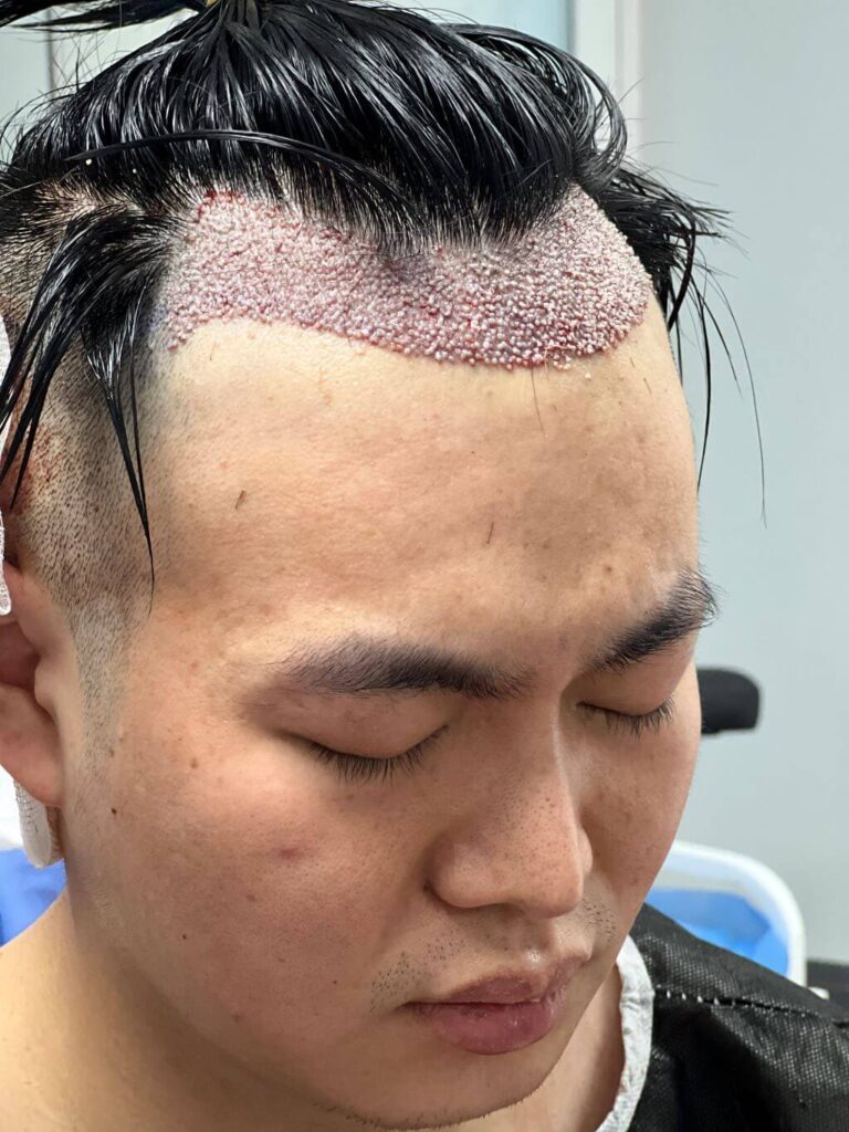 after hair transplant asian patient