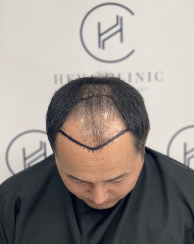 asian hair transplant patient male hair loss