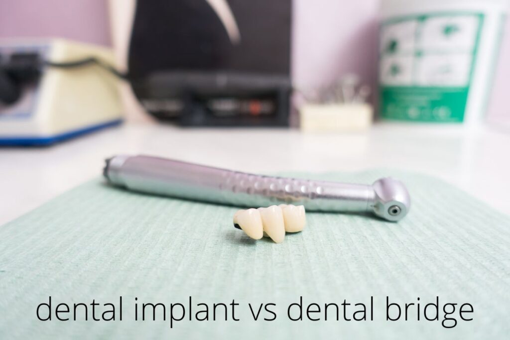 dental implant vs dental bridge
