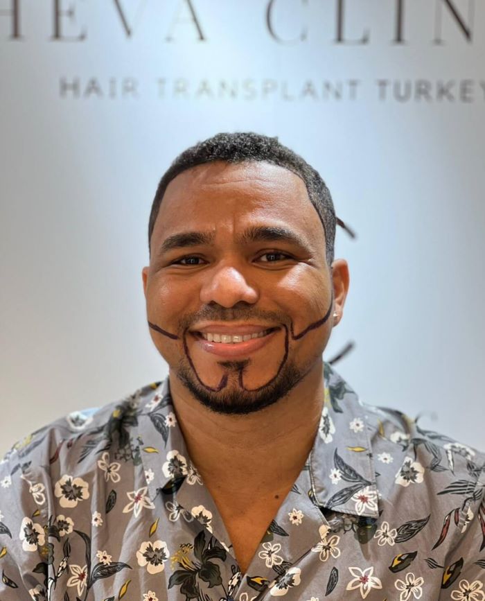 facial hair beard transplant at heva clinic istanbul