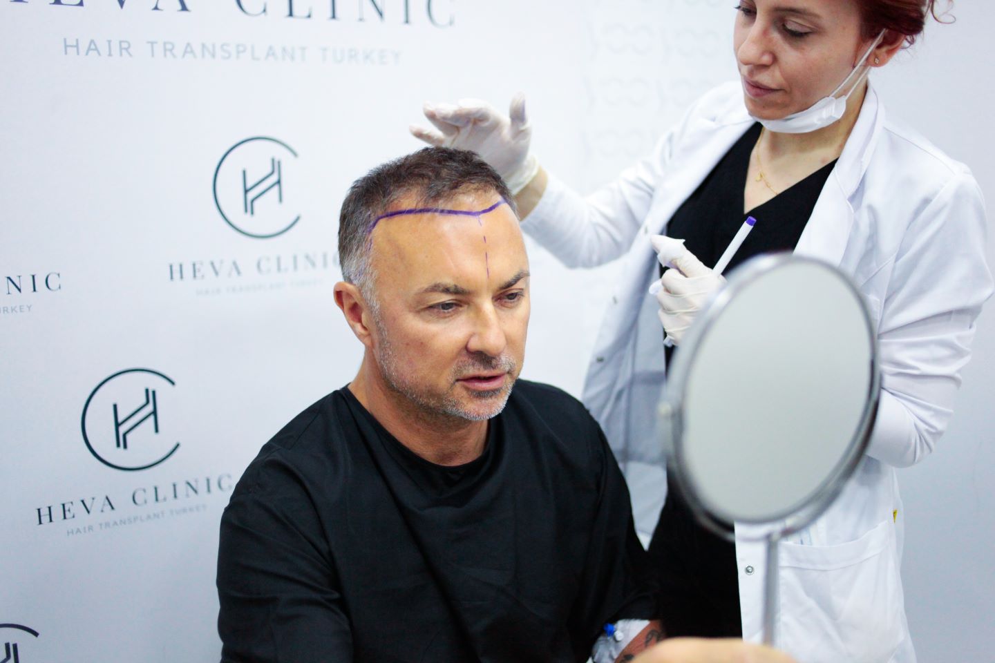 hair transplant experience in turkey, istanbul