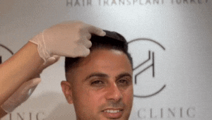 hair transplant result heva clinic istanbul gif