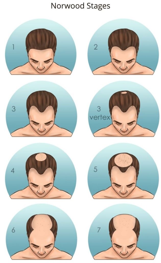 norwood stages for male receding hairline