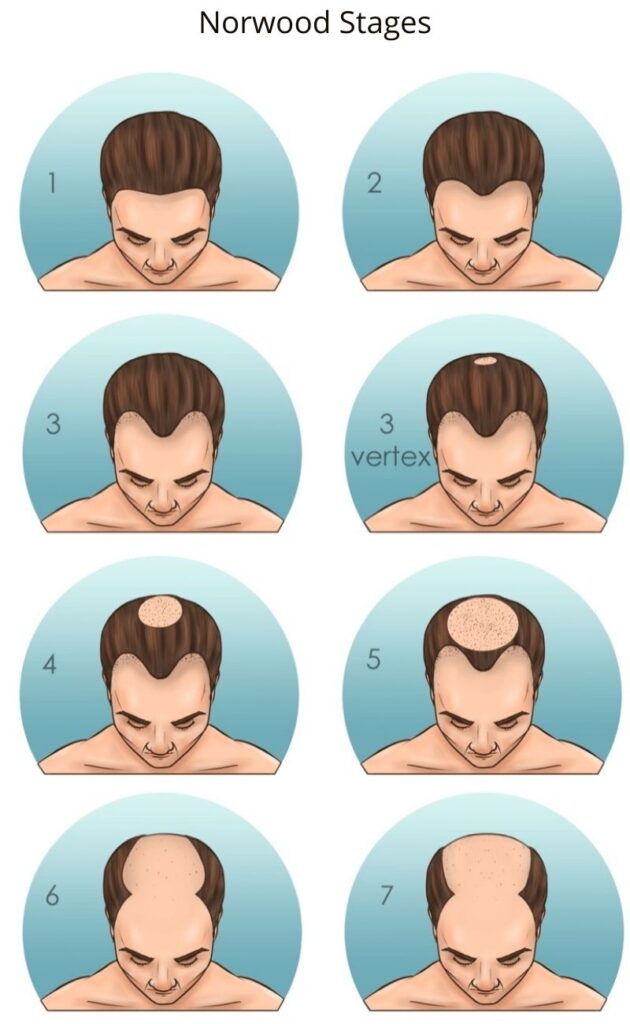 Hair Transplant for Receding Hairline - Heva Clinic