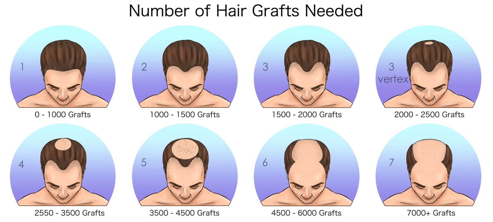number of grafts needed for hair transplant