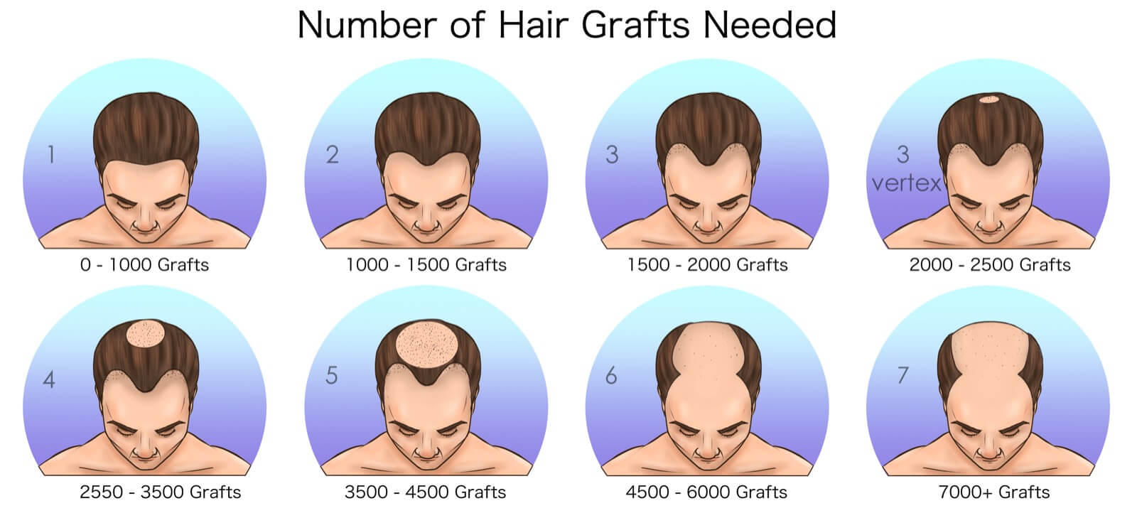Hair Transplant Before & After Photos - Unfiltered Results Gallery Hair Transplant Before & After Photos - Unfiltered Results Gallery