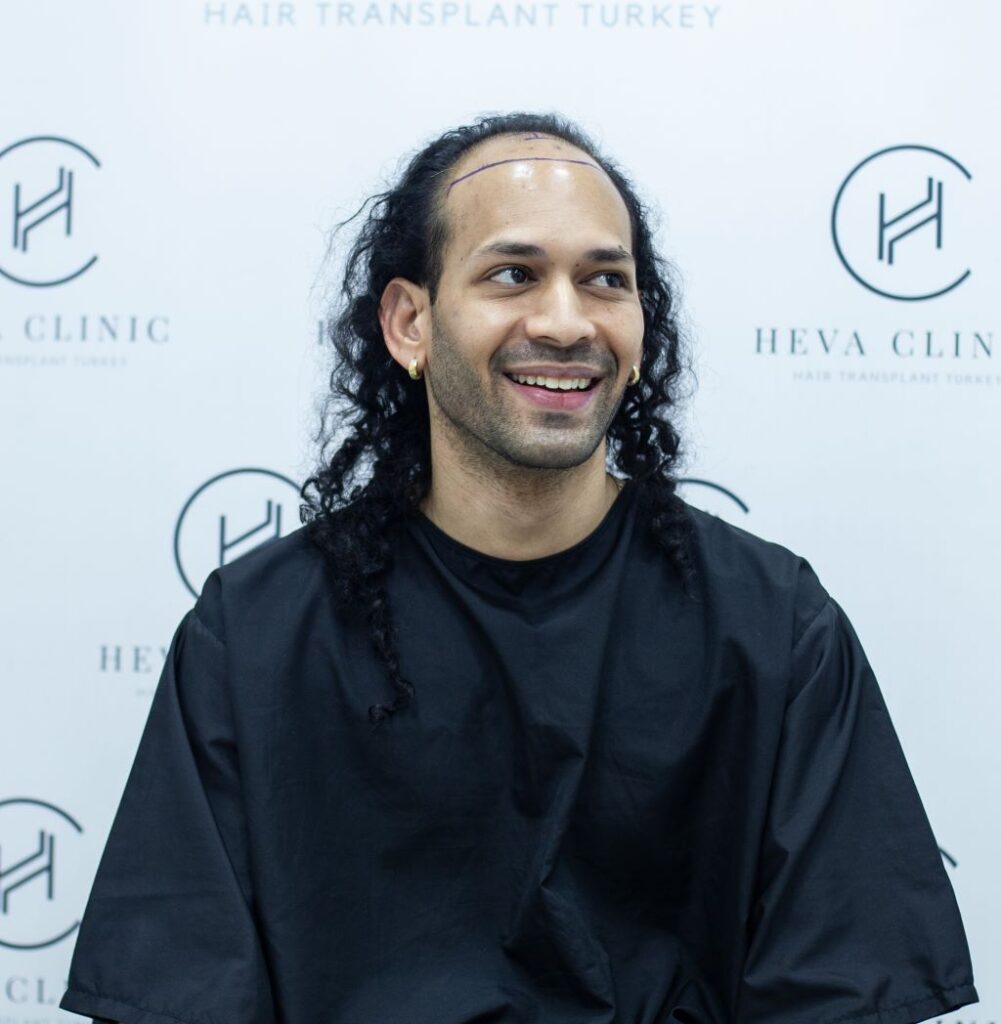 receding hairline hair transplant at heva clinic turkey