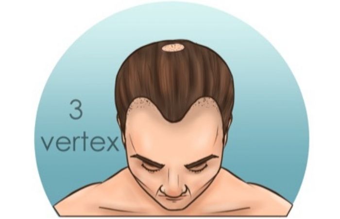 receding hairline norwood stage 3 vertex