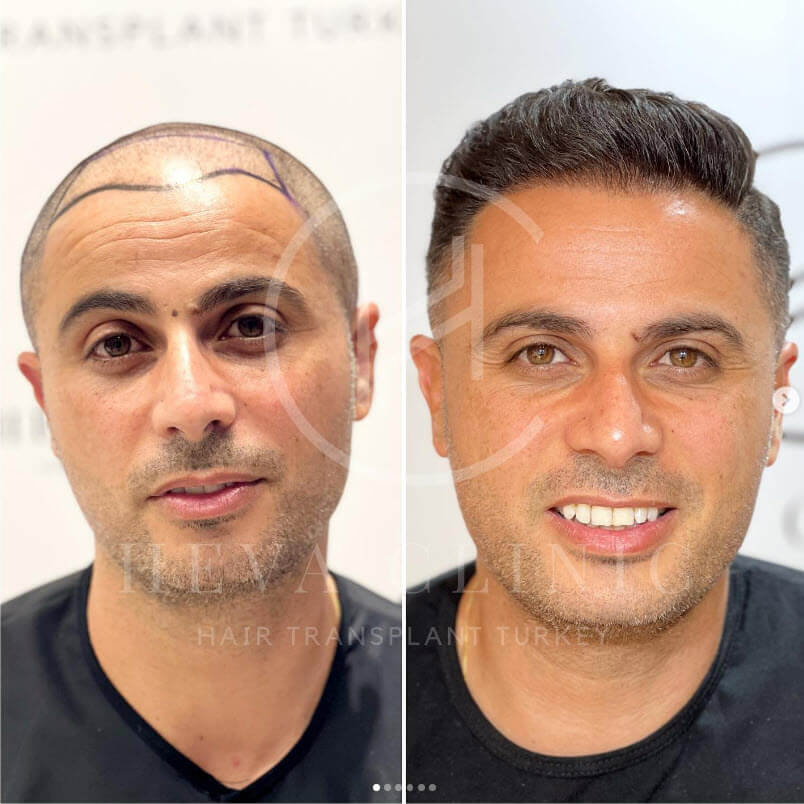 2850 grafts hair transplant 7 months result