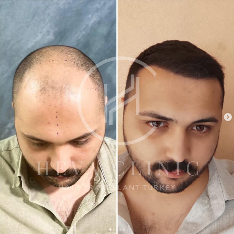 6000 grafts hair transplant at heva clinic istanbul