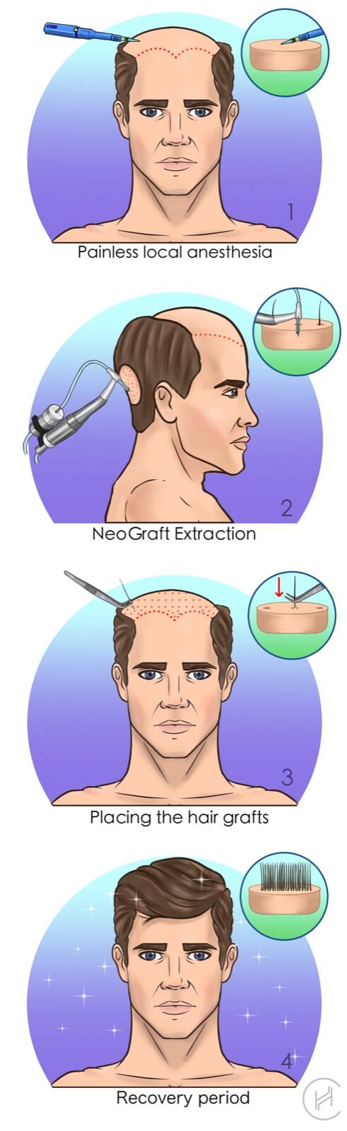 NeoGraft Hair Transplant Procedure Steps