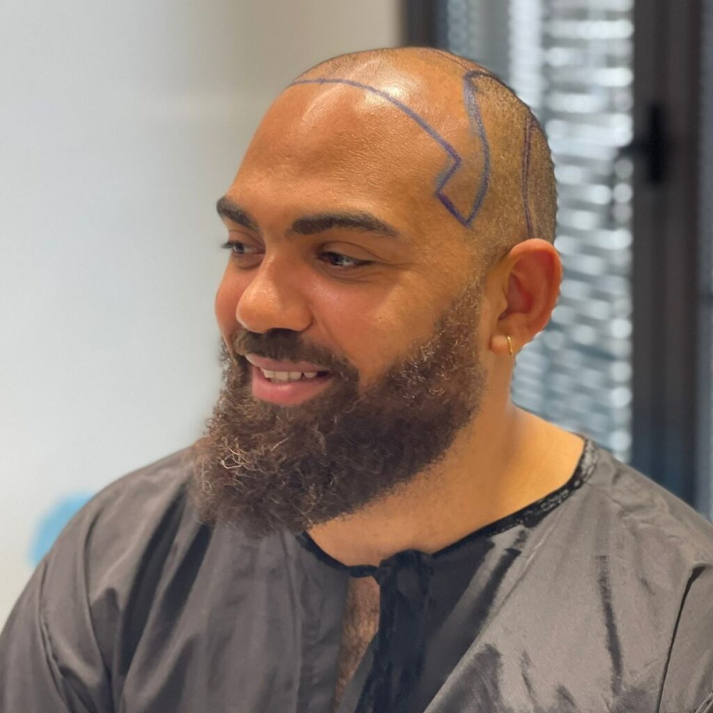 bald male patient