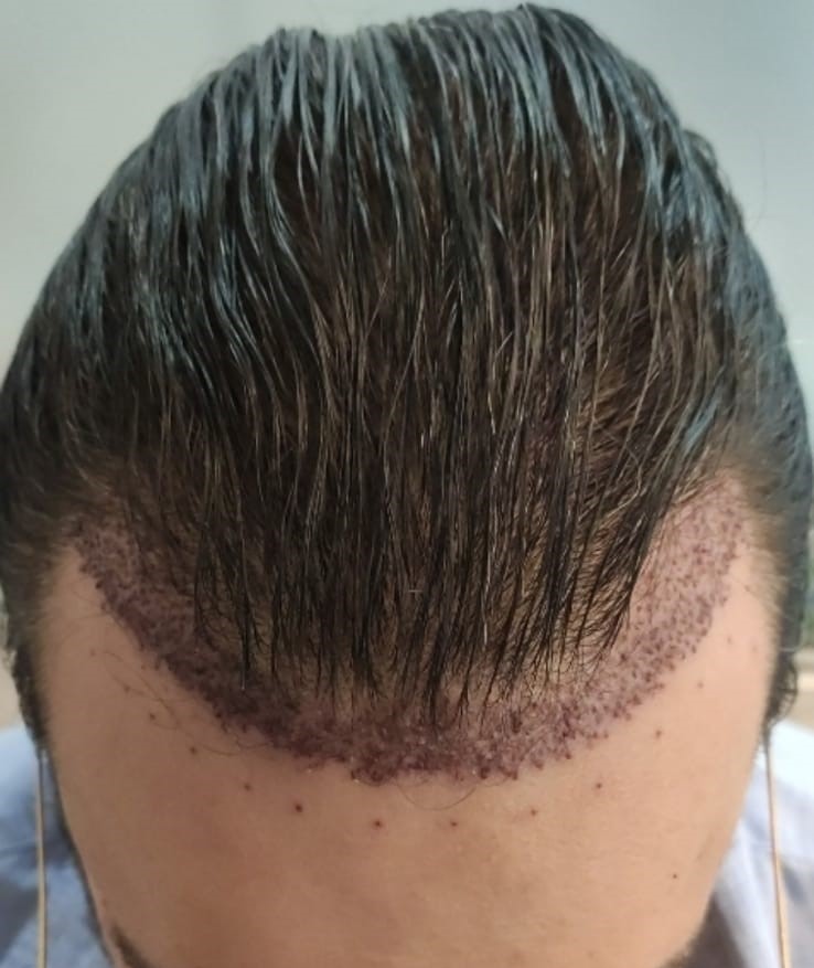 completely unshaven hair transplant front angle