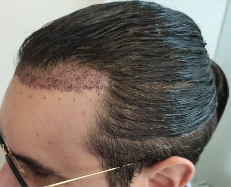 completely unshaven hair transplant right top angle