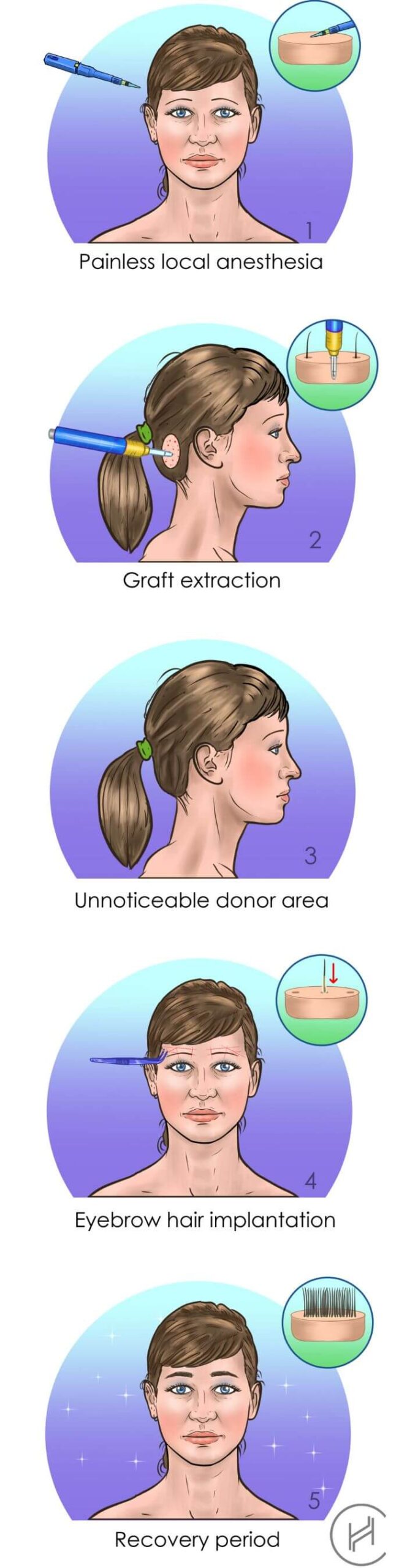 eyebrow transplant female procedure steps