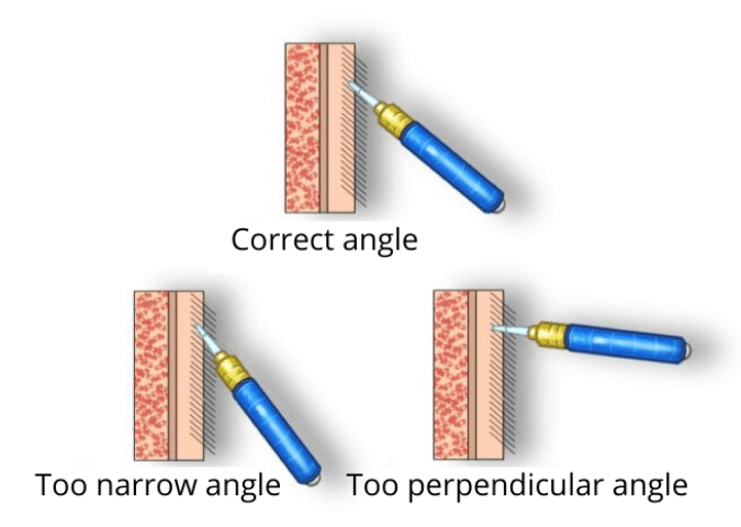 correct graft extraction angle