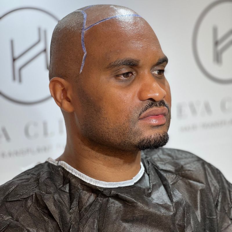 NeoGraft Hair Transplant in Turkey - Procedure & Cost - Heva Clinic NeoGraft Hair Transplant in Turkey - Procedure & Cost - Heva Clinic