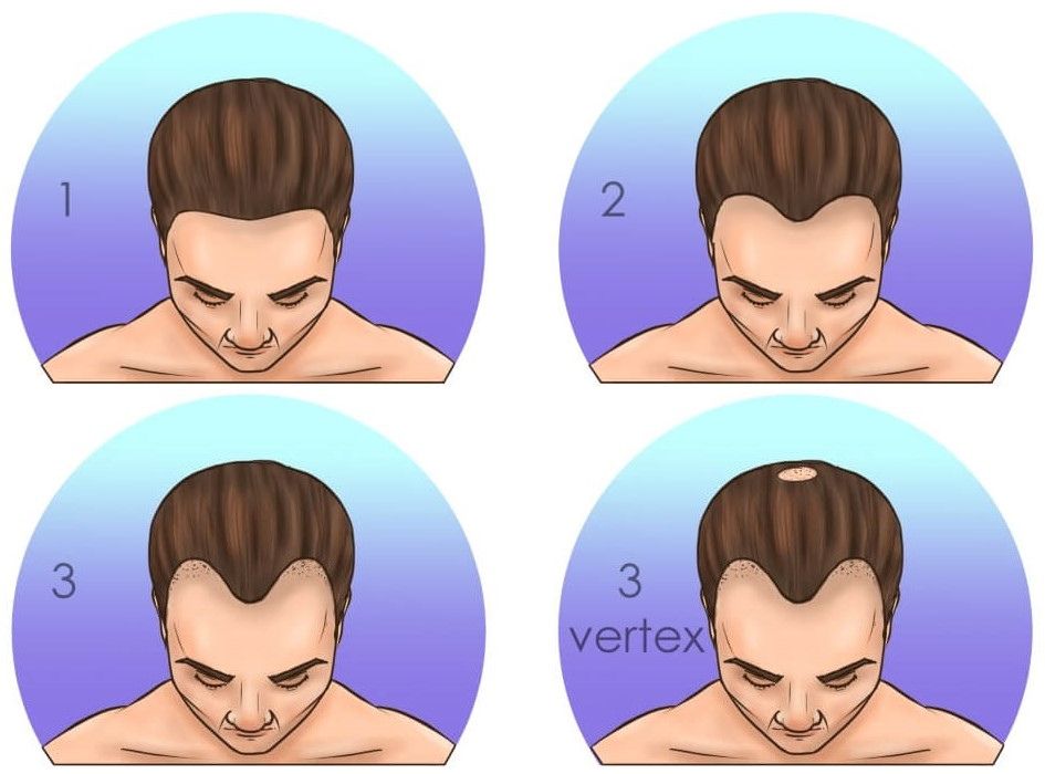 no shave hair transplant candidates norwood 1-3-vertex