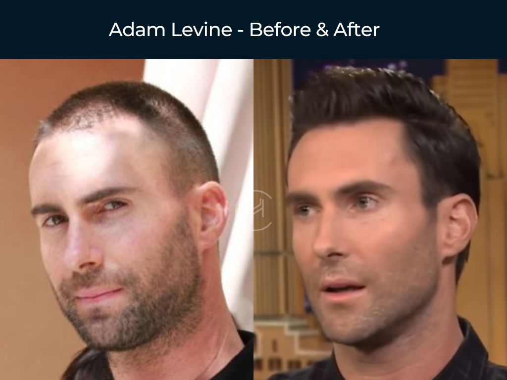 Adam Levine - Hair Transplant Before & After