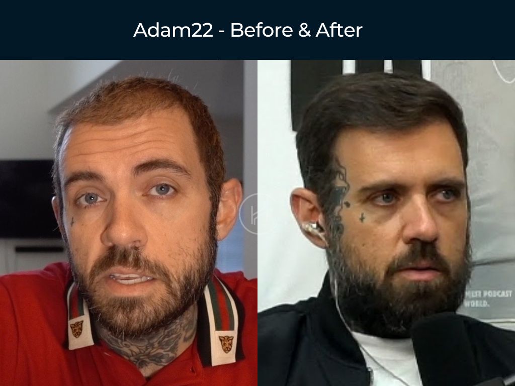 Adam22 - Hair Transplant Before & After