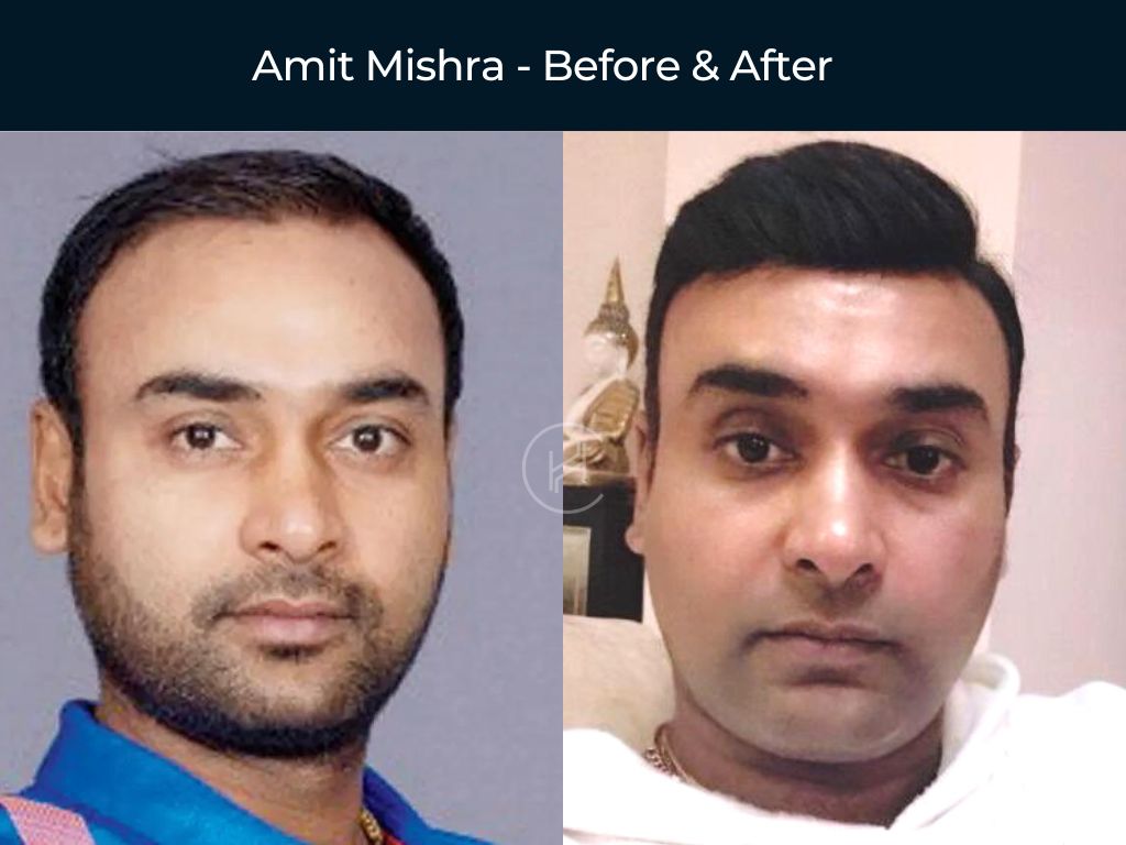 Amit Mishra - Hair Transplant Before & After