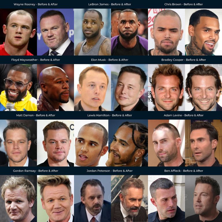 Celebrity hair transplants