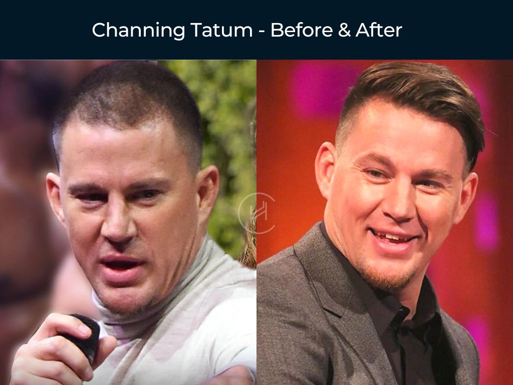 Channing Tatum - Hair Transplant Before & After