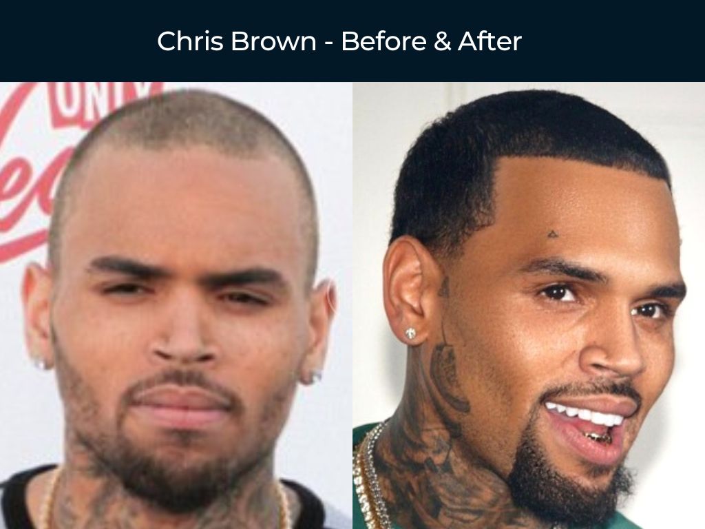 Chris Brown - Hair Transplant Before & After