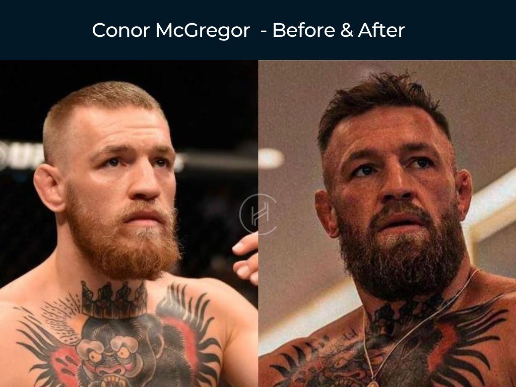 Conor McGregor - Hair Transplant Before & After