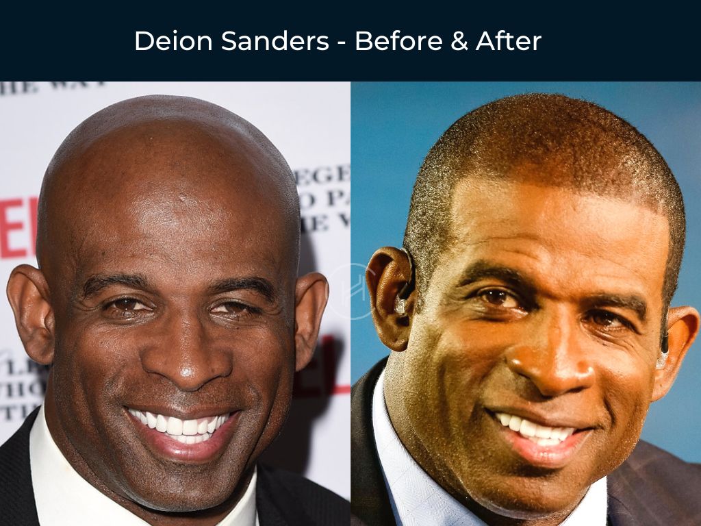 Deion Sanders - Hair Transplant Before & After