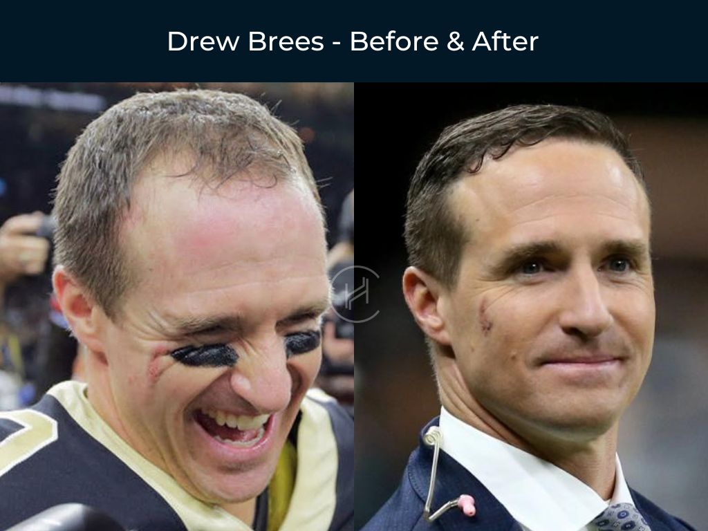 Drew Brees - Hair Transplant Before & After