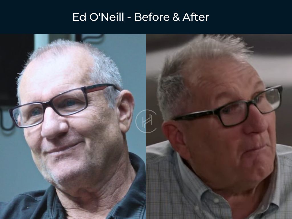 Ed O'Neill - Hair Transplant Before & After