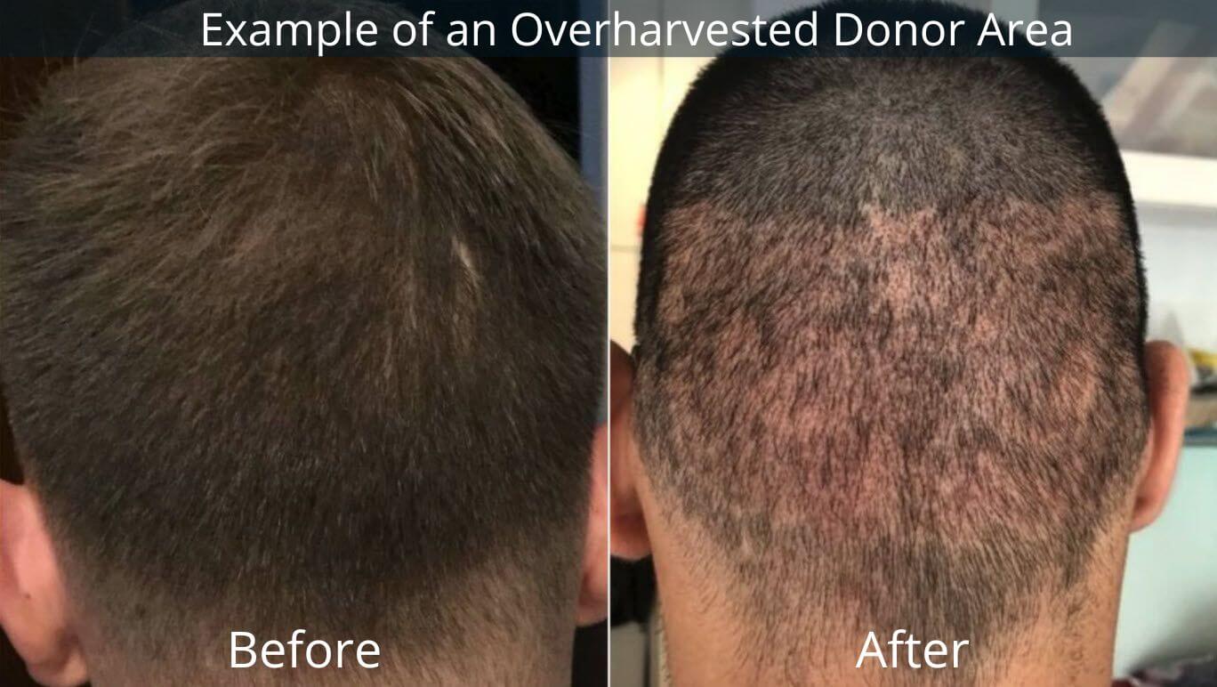 What Is The Oveharvested Donor Area In Hair Transplant?