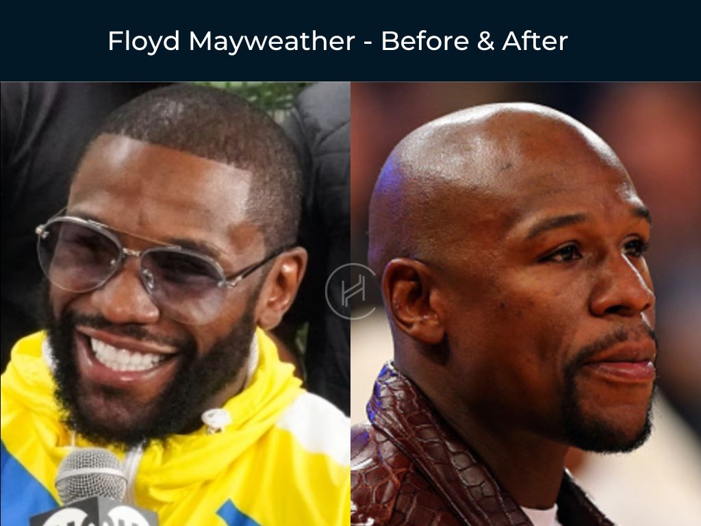 Floyd Mayweather - Hair Transplant Before & After