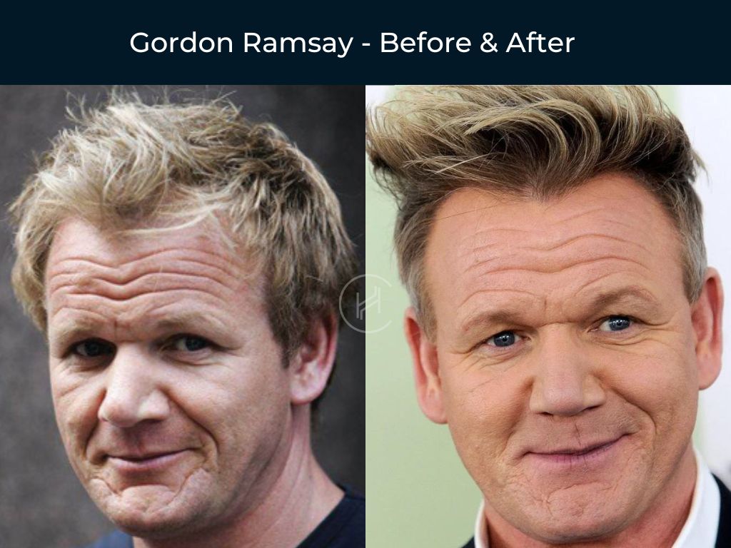56 Celebrity Hair Transplants | Before & After Photos 56 Celebrity Hair Transplants | Before & After Photos