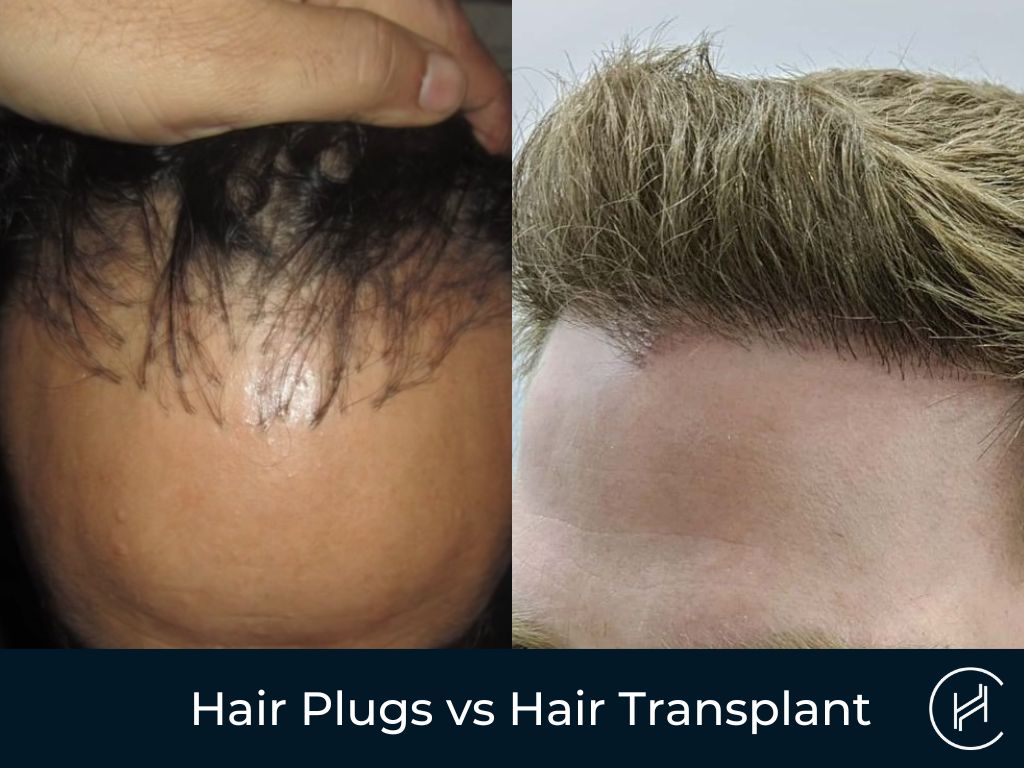Hair Plugs vs Hair Transplant - Do You Know The Difference? Hair Plugs vs Hair Transplant - Do You Know The Difference?