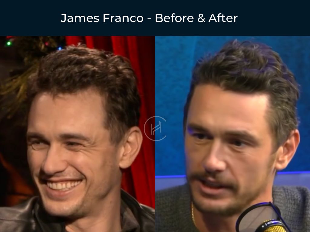 James Franco - Hair Transplant Before & After