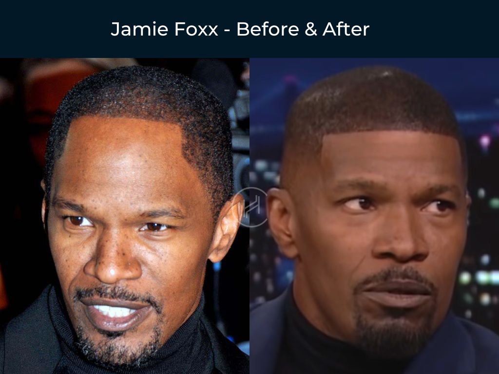 Jamie Foxx - Hair Transplant Before & After