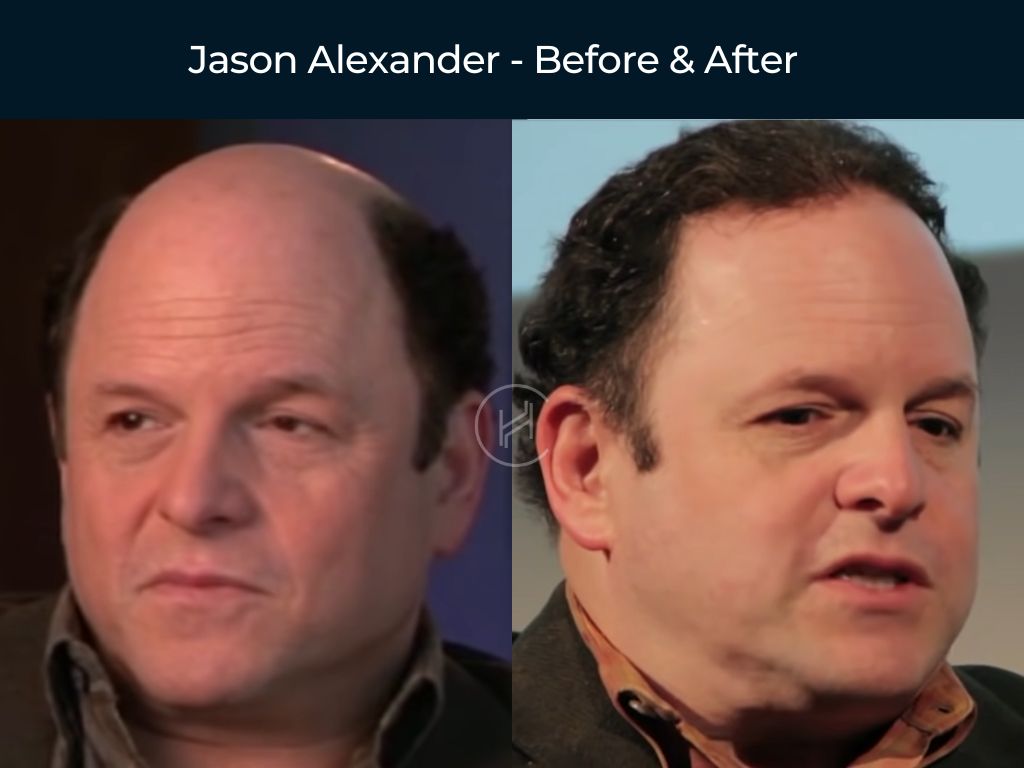 Jason Alexander - Before & After