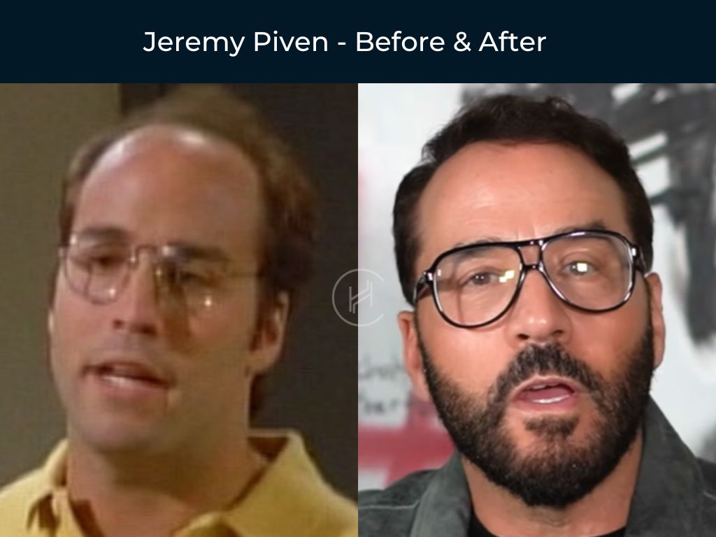 Jeremy Piven - Hair Transplant Before & After