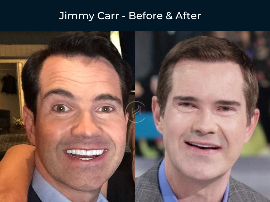 Jimmy Carr - Hair Transplant Before & After