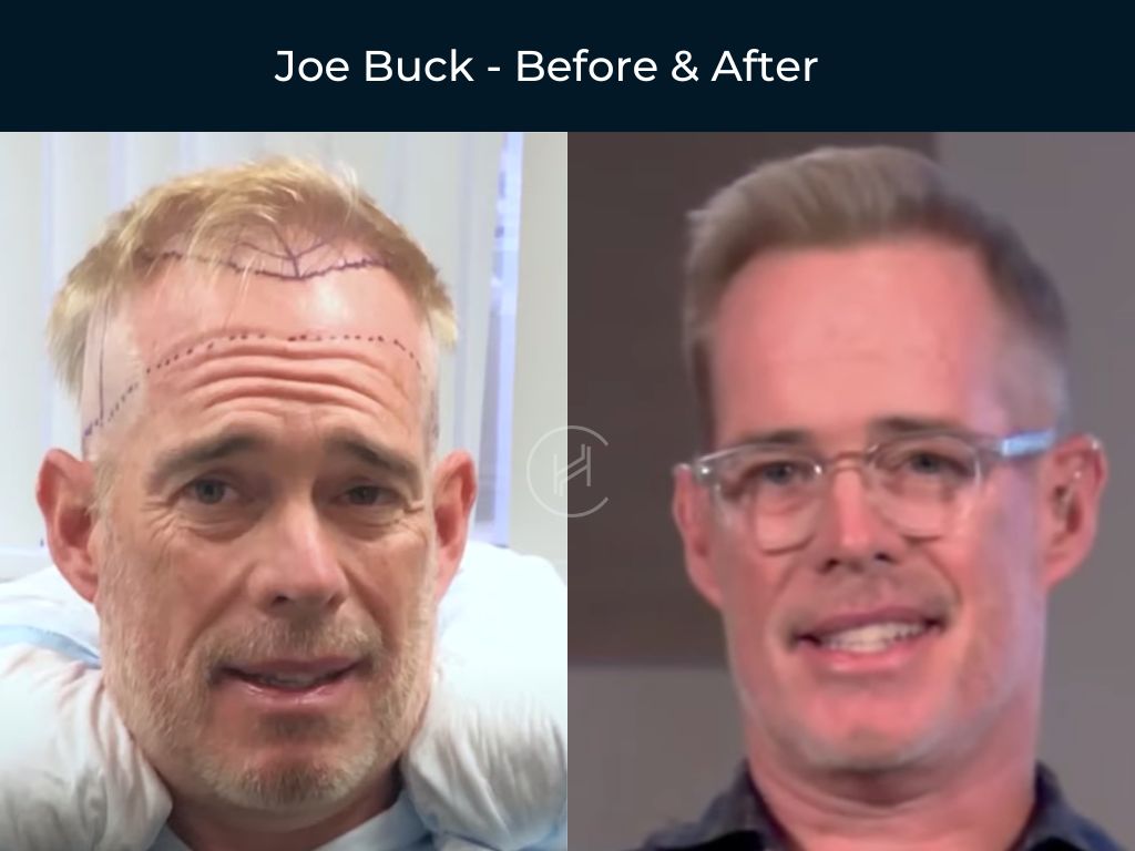 Joe Buck - Hair Transplant Before & After